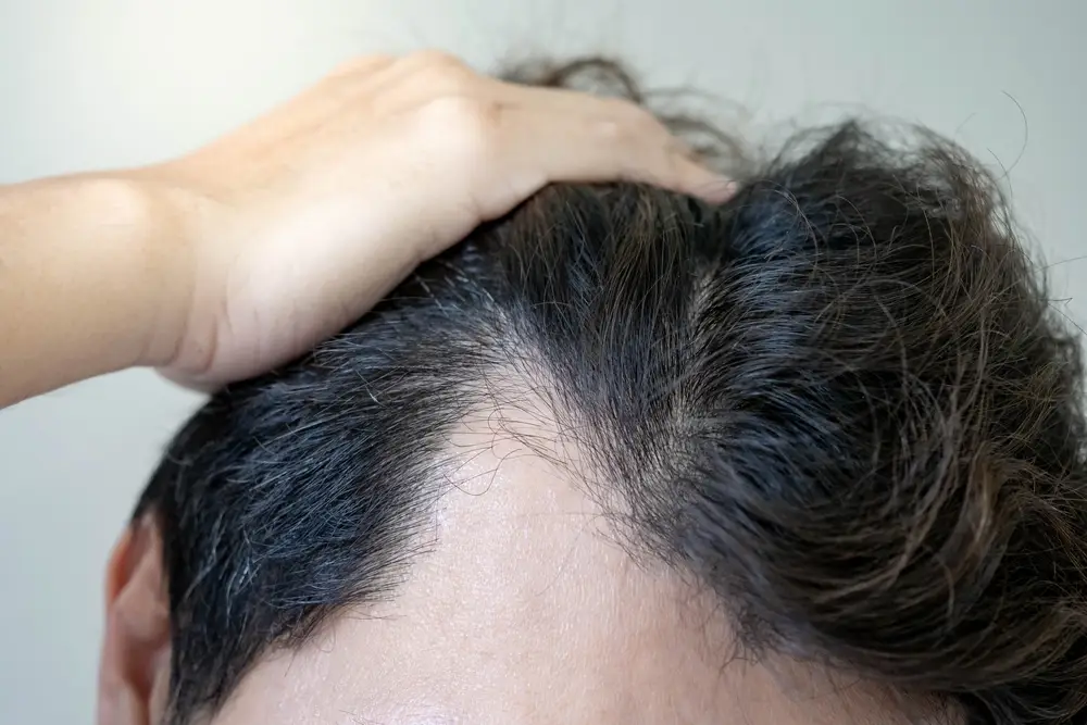 Finasteride / Minoxidil 30 mL