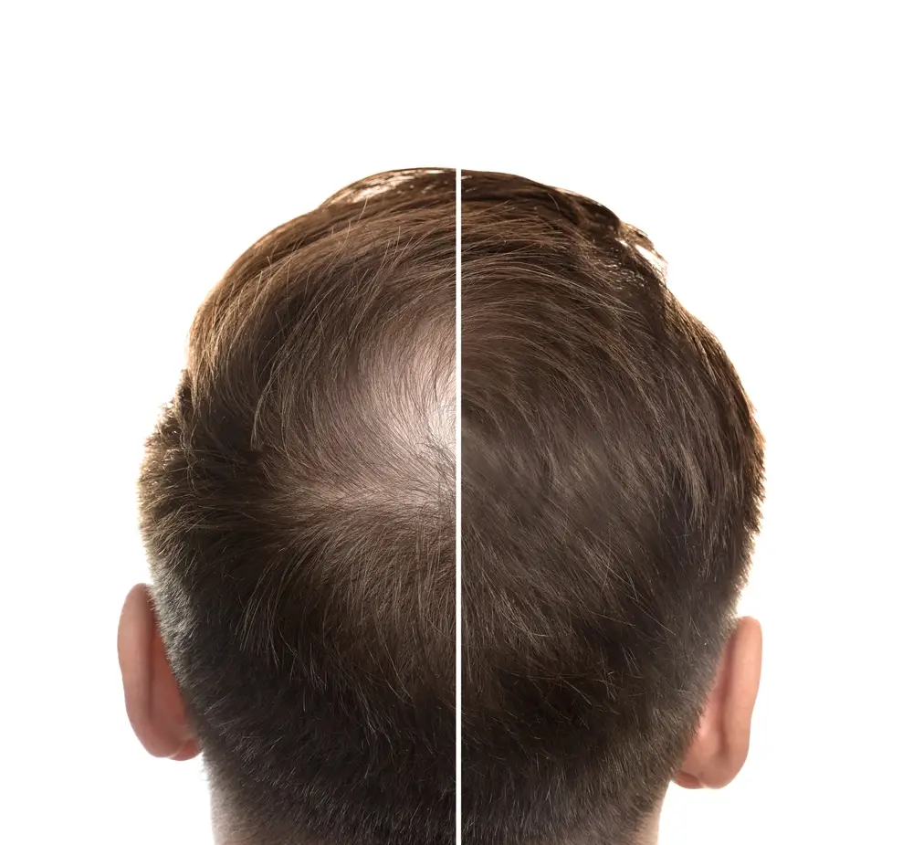 Before and after comparison of hair regrowth on a man's scalp
